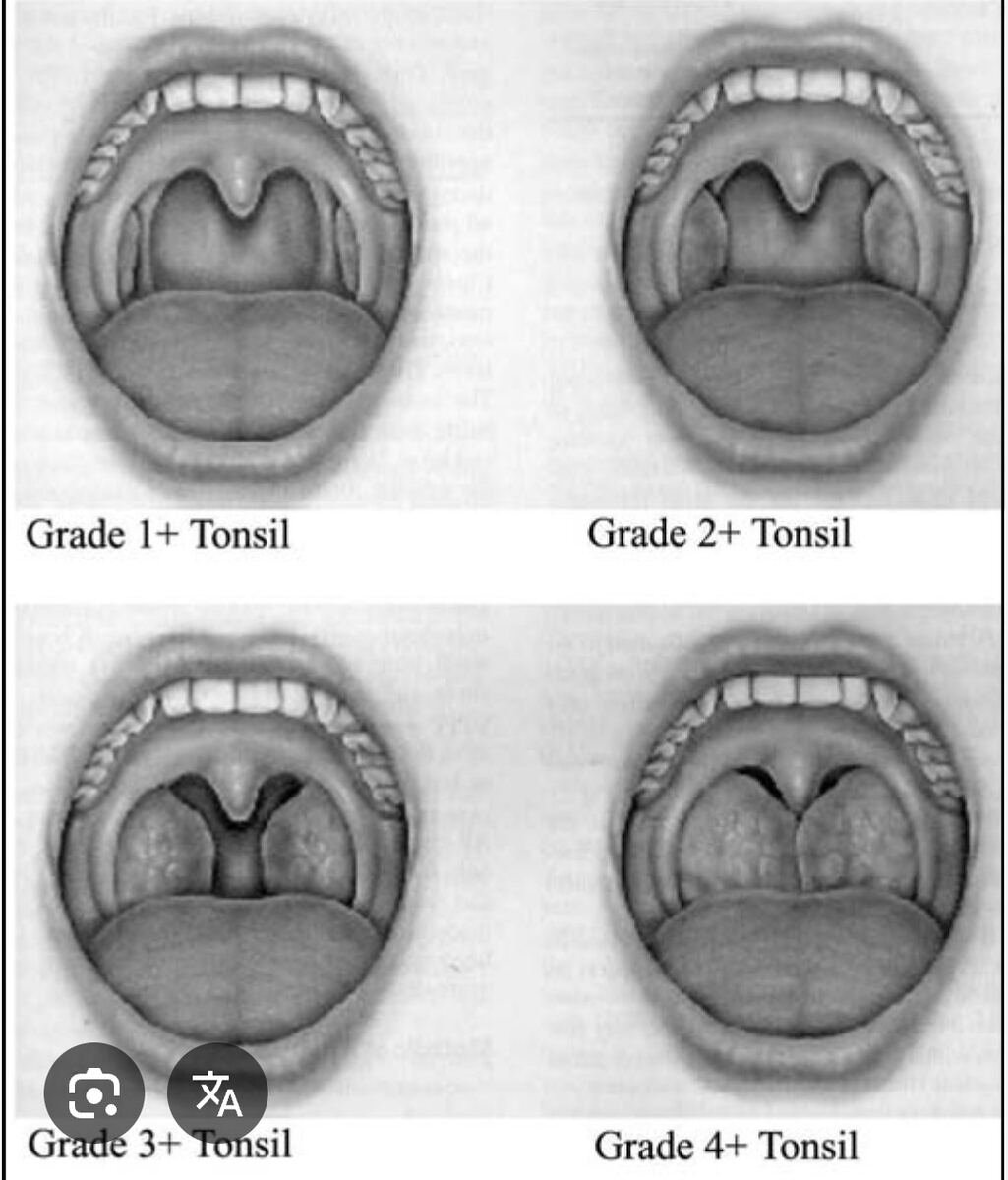 Amygdalectomie — classification du volume amygdalien