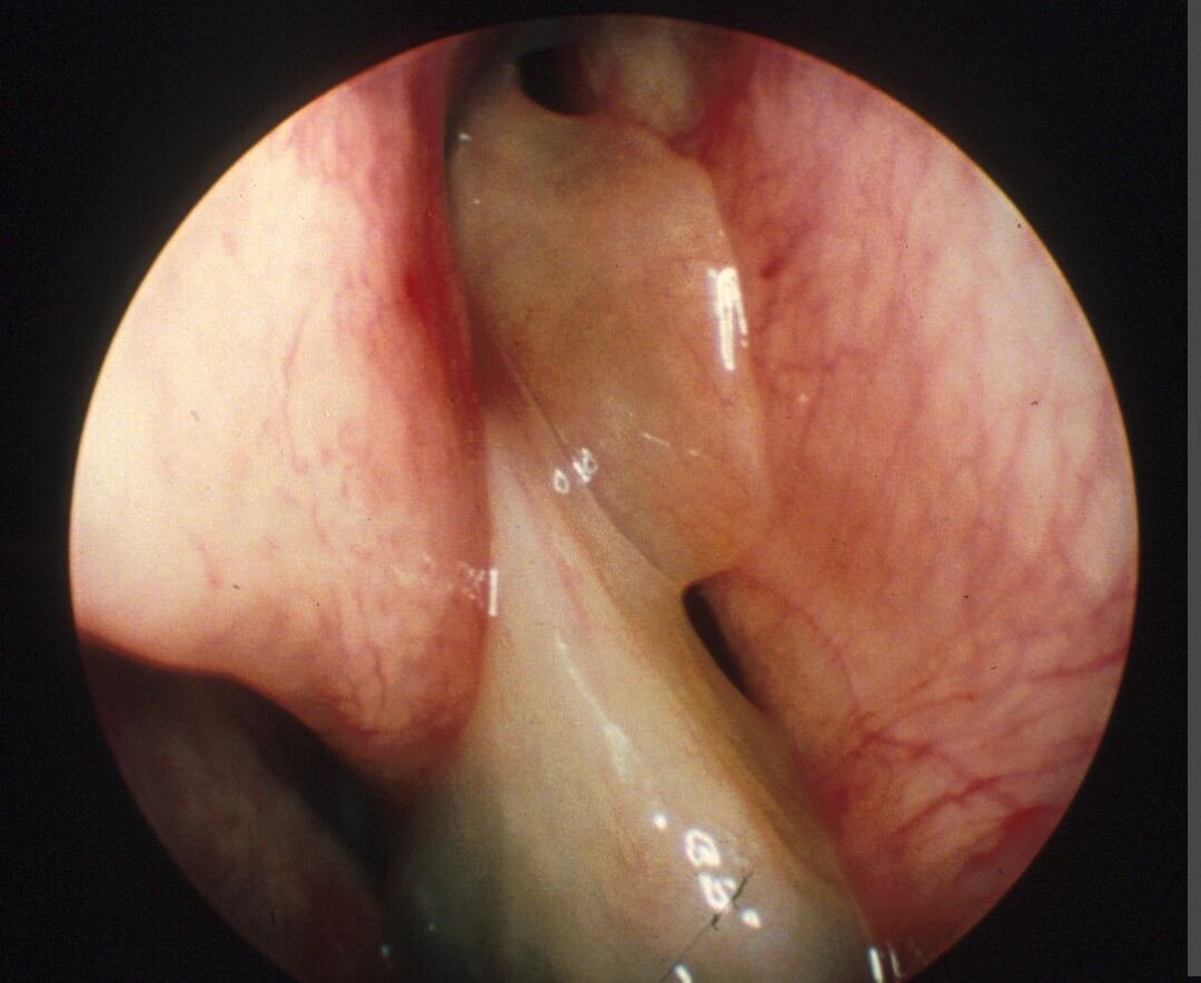 Septoplastie — vue endoscopique de la cloison nasale