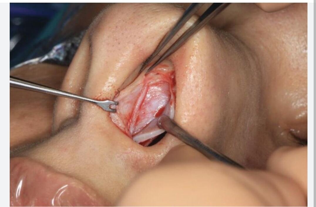 Chirurgie de la sinusite — geste opératoire
