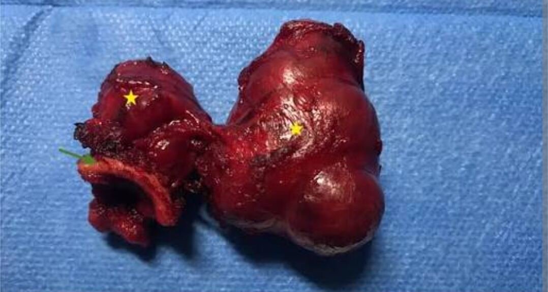 Thyroïdectomie — pièce opératoire