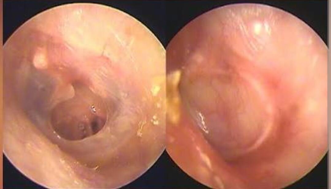 Tympanoplastie — vue otoscopique du tympan